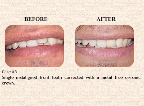 Teeth Whitening in Civil Lines