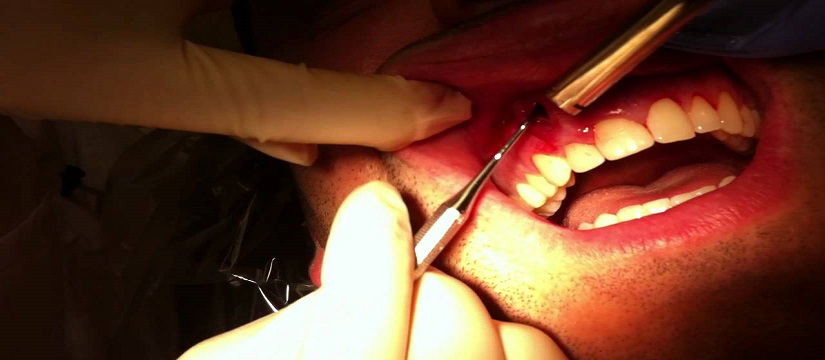 Simple non-surgical extraction-osp3