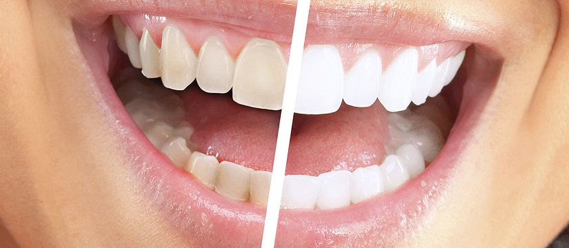 Teeth whitening bleaching