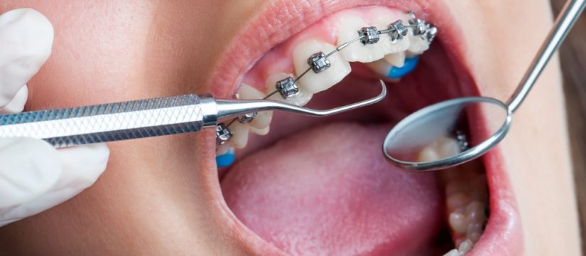 Dental Implant in Malka Ganj