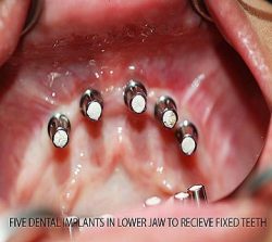 dentalimplantcase1
