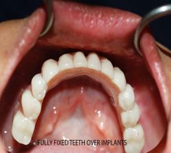 dentalimplantcase2