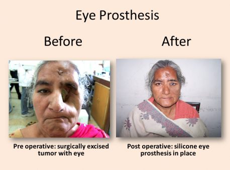 Best Eye Prosthesis Treatment