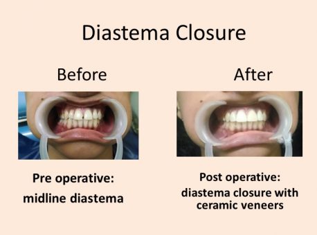 smilekonnekt dental treatment phase