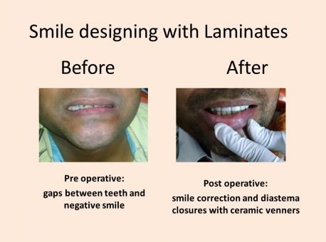 Smile Designing Dentist in Delhi
