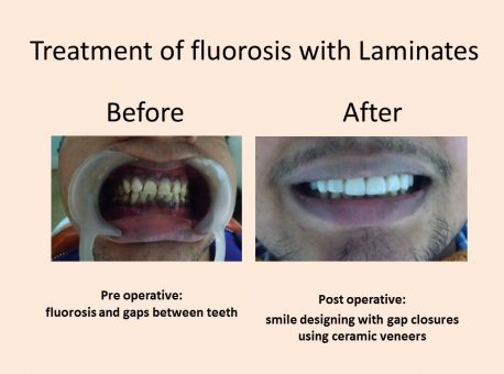 Dental Fluorosis Treatment Clinic