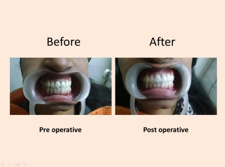 Oral Lesion Dental Clinic Delhi