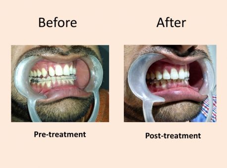 Restorative Dentistry Delhi