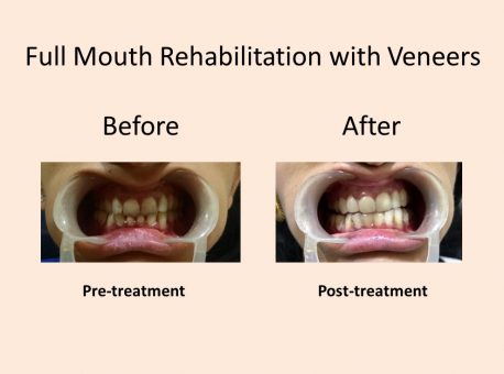 Full Mouth Rehabilitation with veneers