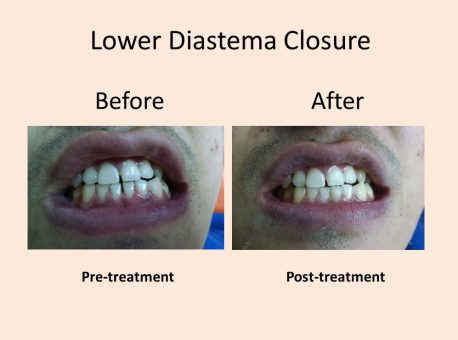 Lower Diastema Closure