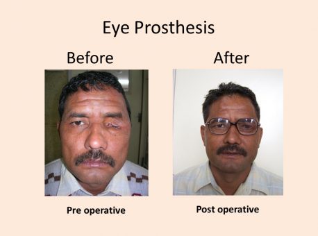 Eye Prosthesis Clinic Delhi