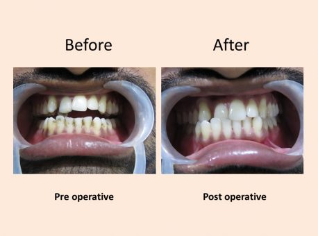 Endodontics Treatment Delhi