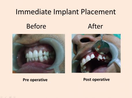 dental implant delhi